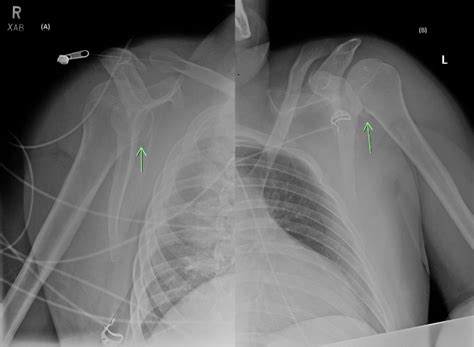 Figure 1 From Simultaneous Isolated Avulsion Fractures Of The Lesser