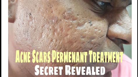 Acne Scars Permanent Treatment How To Remove Acne Scars Secret