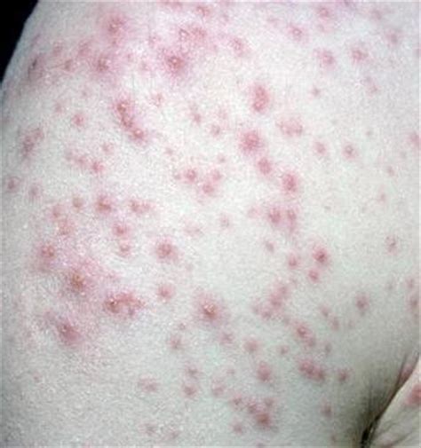 The virus is embedded in the blisters. Resources for General Practice: Viral Rashes
