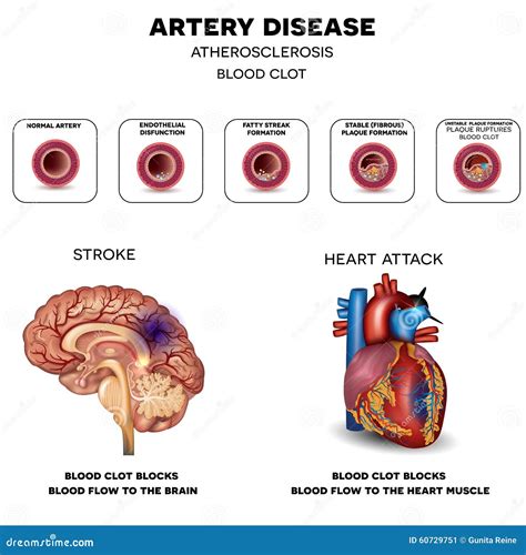 Artery Disease Atherosclerosis Stock Vector Image 60729751