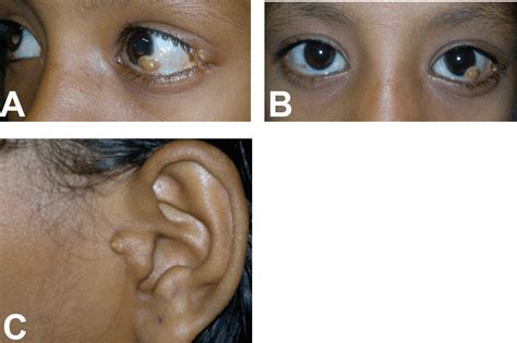 Full Text Goldenhar Syndrome Presenting As Limbal Dermoid Cyst A