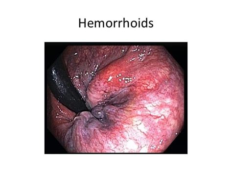 Hemorrhoids tend to flare and then go away, so bleeding patterns are more erratic and circumstantial. How to Deal with Symptoms of Hemorrhoids | BowelPrepGuide