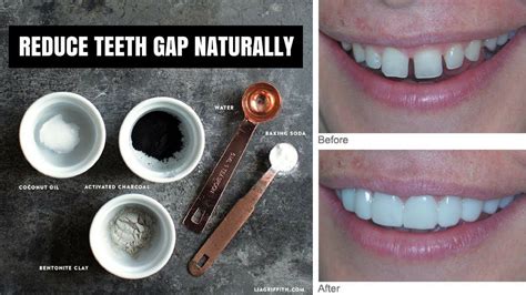 We did not find results for: How To Close Small Gaps In Teeth Without Braces - TeethWalls