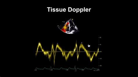 Echocardiography Essentials Evaluating Right Ventricular Size And