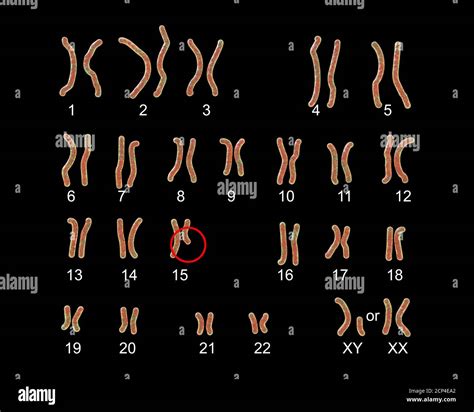 Karyotype Of Prader Willi Syndrome Computer Illustration This Is A Genetic Disorder Caused By