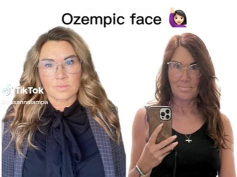 Rosto de Ozempic Médica explica técnicas que resolvem aspecto caído
