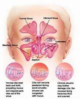 Pictures of Enlarged Turbinates Treatment