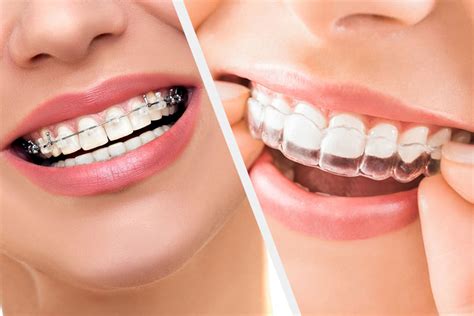 orthodontics australia traditional braces vs clear aligners