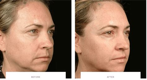 Laser Skin Tightening Before And After Thermage Morpheus8 Ultherapy
