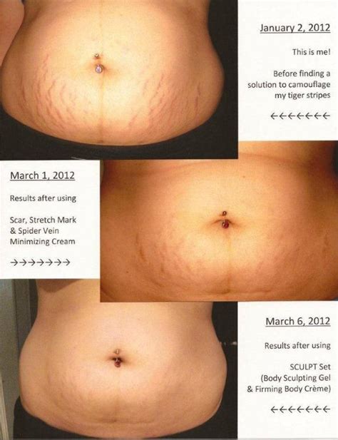 Bc Scar Stretch Mark And Spider Vein Cream Before And After Spider