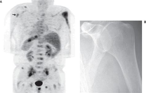 Musculoskeletal Tumors Radiology Key