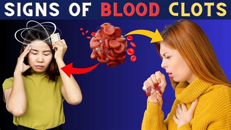 Warning 8 Signs That You Have A Blood Clots Warning Signs Of Blood