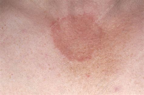 Ringworm Fungal Infection