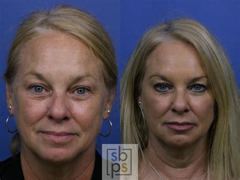 Dermal Fillers Before And After Pictures Case 270 Torrance Ca