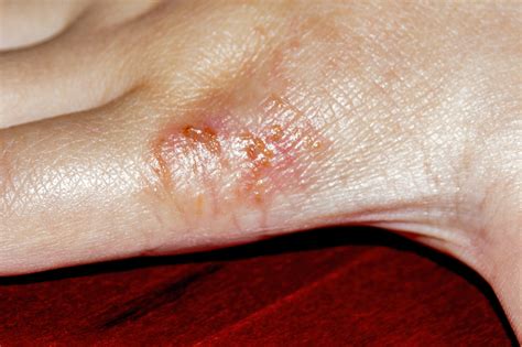 Eczema What To Do About This Common But Complex Skin Condition