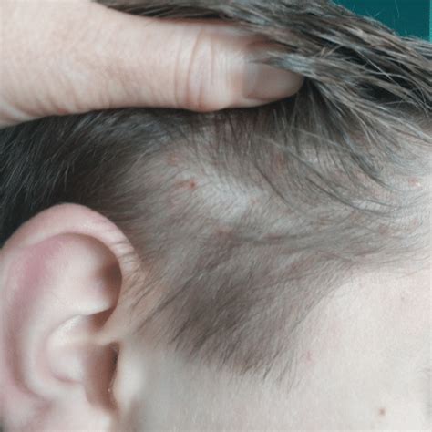 17 Lice Symptoms With Pictures Signs That You Have Head Lice My Lice