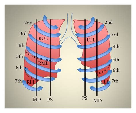 Anterior View Of The Lung Schematic Representation Of Pulmonary Lobes