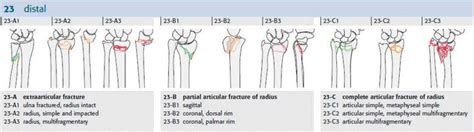 Ao Classification Distal Radius Fracture