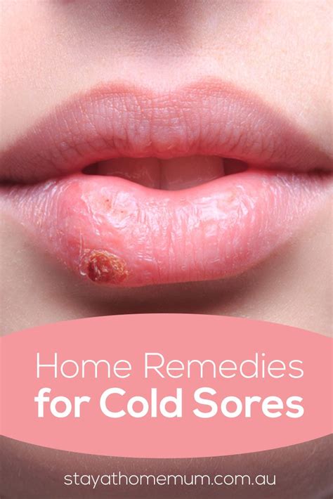 How To Cover A Cold Sore Scab On Lip Be The First Portal Picture Gallery