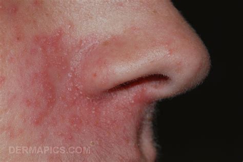 Dermatitis Herpetiformis Nose