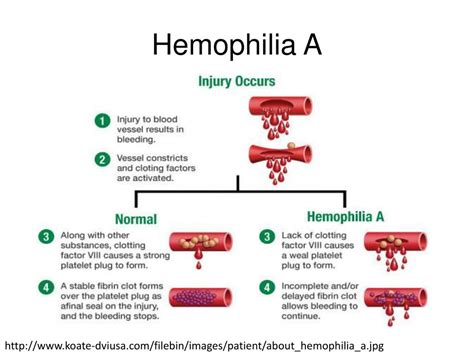 Ppt Hemophilia A And Coagulation Factor 8 Powerpoint Presentation