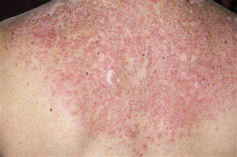 Lupus Rash On Back Triggered By Sun Stock Image C0069165 Science