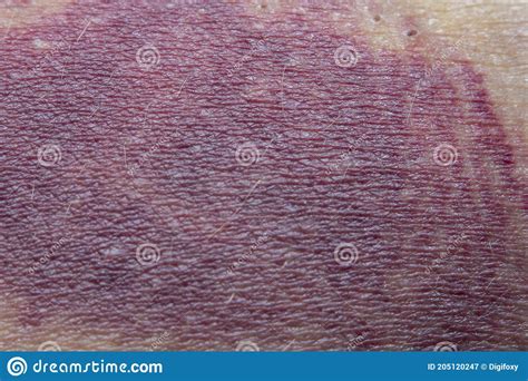 Bruise On Man Arm Injection Bruises Purple Veins On The Wrist Royalty Free Stock Photography