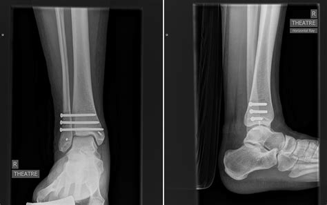 Open Ankle Dislocation Without Fractures With Tibialis Posterior Tendon