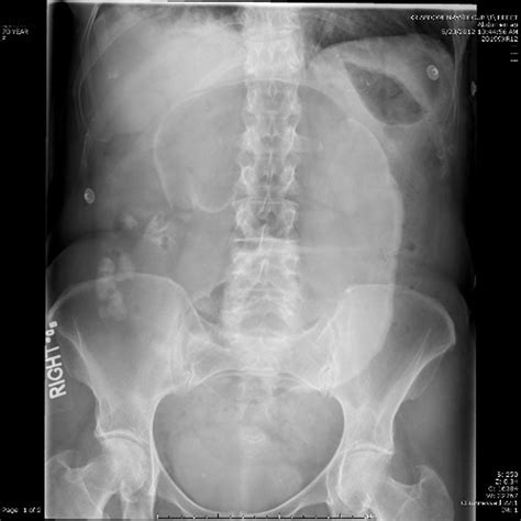 Störung der darmentleerung, wobei weder stuhl noch gase entweichen (sog. Darmverschluss - Gastrointestinale Erkrankungen - MSD ...