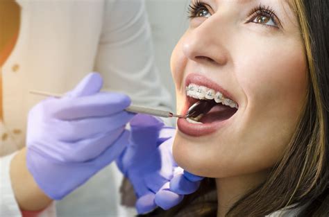 How To Whiten Your Teeth With Braces El Dorado Hills Orthodontist Jk Orthodontics