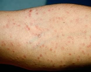 häufigsten Infektionskrankheiten der Haut SpringerLink