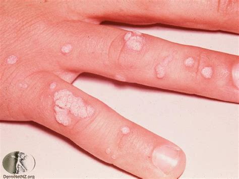 Common Warts Craig Singer Md Dermatology