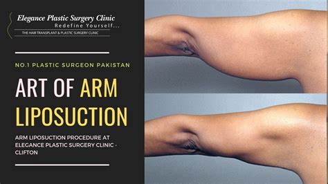Arm Liposuction By Dr Faisal Akhlaq Elegance Plastic Surgery Clinic
