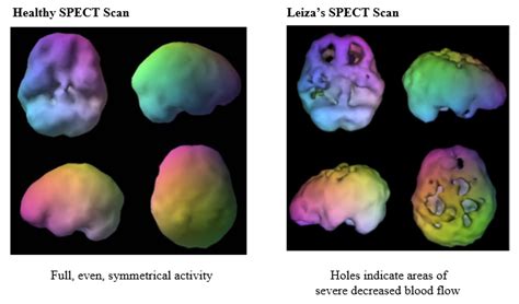 Depression Brain Scan Help Health