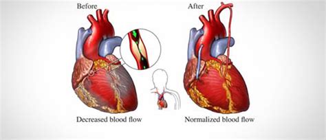 Heart Bypass Surgery What Is Heart Bypass Surgery
