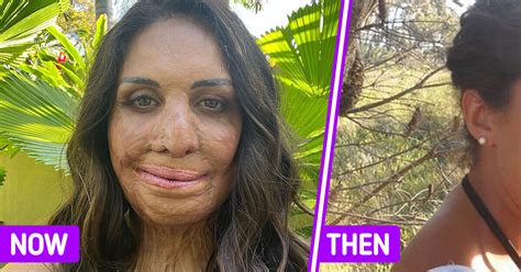 The Remarkable Story Of Turia Pitt Who Survived A Deadly Fire And Accepted A New Self With Her