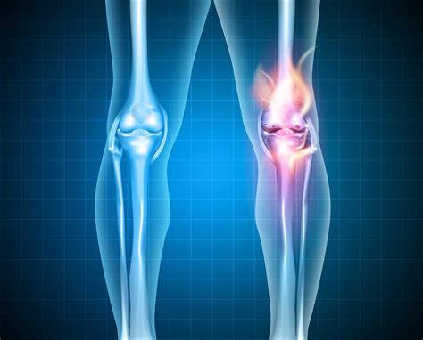 Salt Lake City Ut Knee Replacement Surgery Medical Malpractice Errors