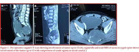 Figure 1 From Wide Local Resection Of Sacral Chordoma Through Posterior