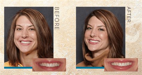 How Jacquelynn Got A Wider Smile Video Gorman Center For Fine Dentistry
