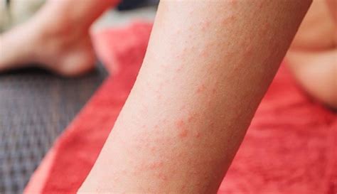 Top 19 Symptoms Of Celiac Disease Skin Rash 2023