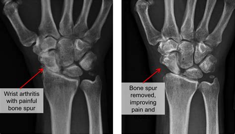 Wrist Arthritis Raleigh Hand Surgery — Joseph J Schreiber Md