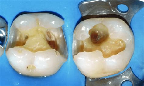 Molar Cavities After Removal Of Restorations And Cleansing Of Lesions