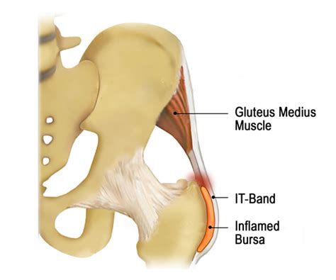 Lateral Hip Pain Bursitis Or Tendinosis Erik Dalton Blog