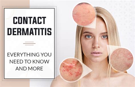 Contact Dermatitis Everything You Need To Know And More Ws Dermatology