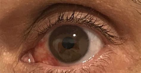 Derrame Ocular ¿qué Hacer Si Aparece Un Derrame En El Ojo