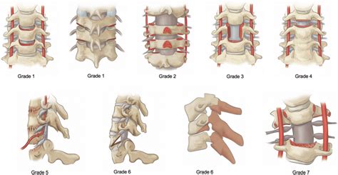 Modified Classification Of Cervical Osteotomies According To The