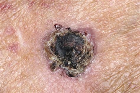 Skin Cancer Squamous Cell Carcinoma Stock Image M1310748