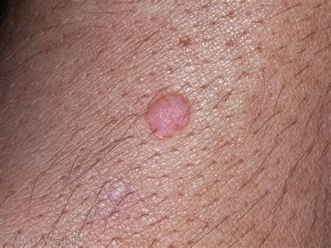 Every Type Of Wart And How To Treat It Visual Guide A