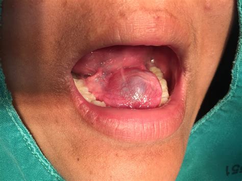 Salivary Gland Disorders And Tumours Revise Dental