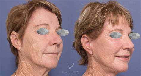 Facelift And Neck Lift Valley Plastic Surgery Plastic